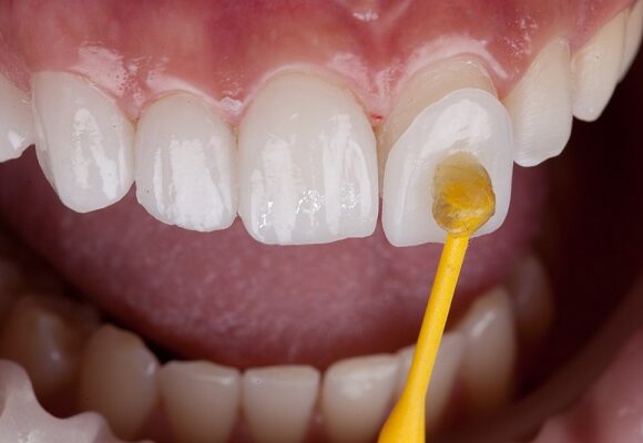 Porcelain Veneers