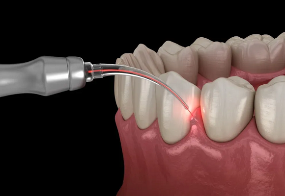 Gum Surgery